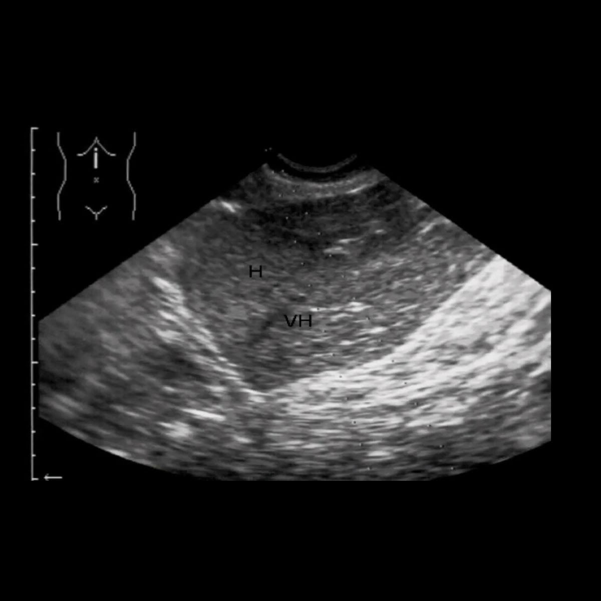 HEPATITIS Clínica de Alta Especialidad